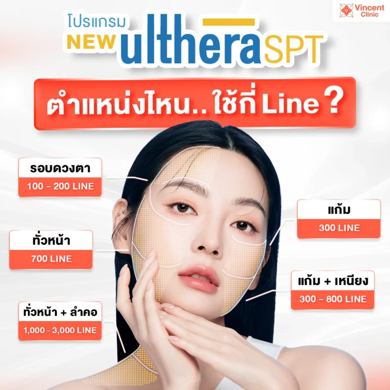 ทำ Ulthera SPT ตำแหน่งไหนใช้กี่ Line