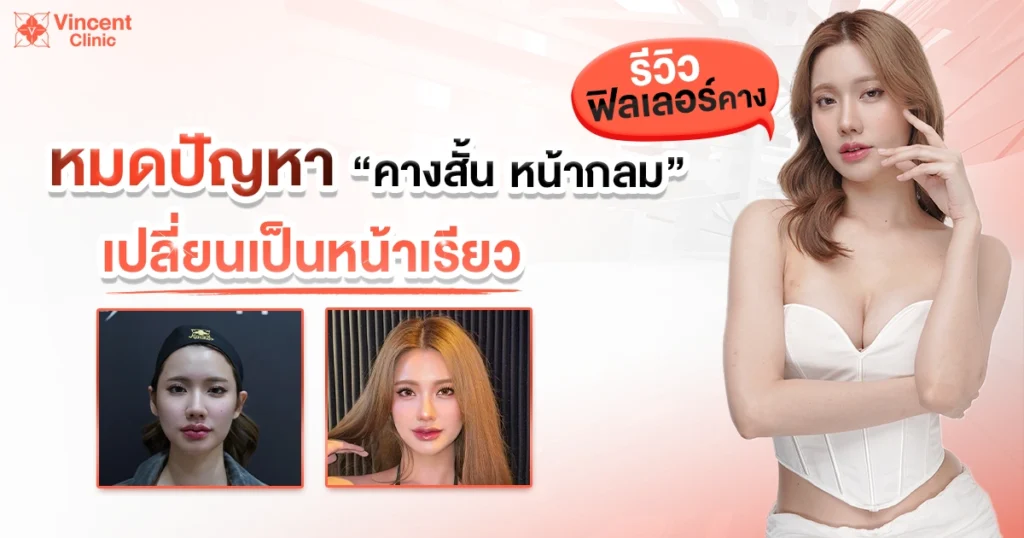 รีวิวฟิลเลอร์คาง