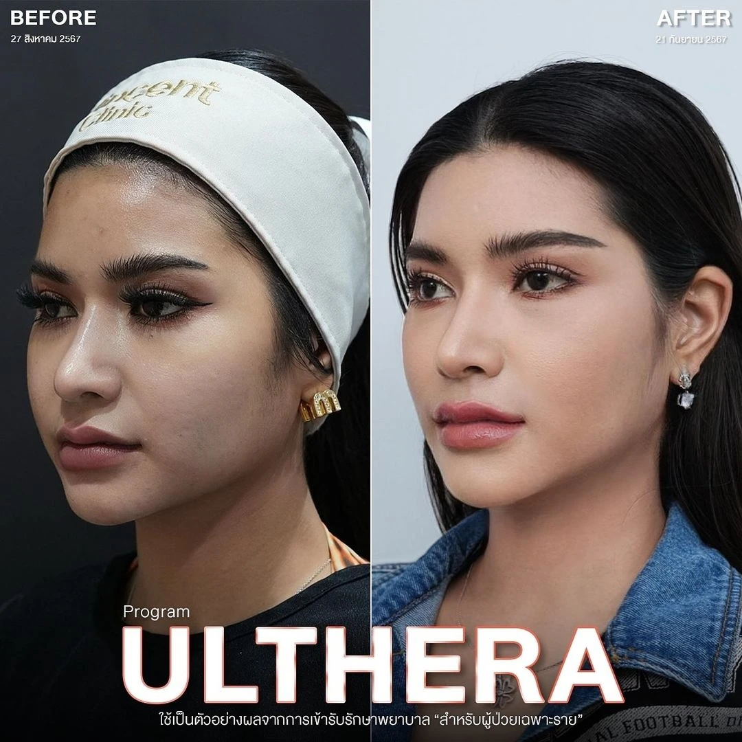 ulthera