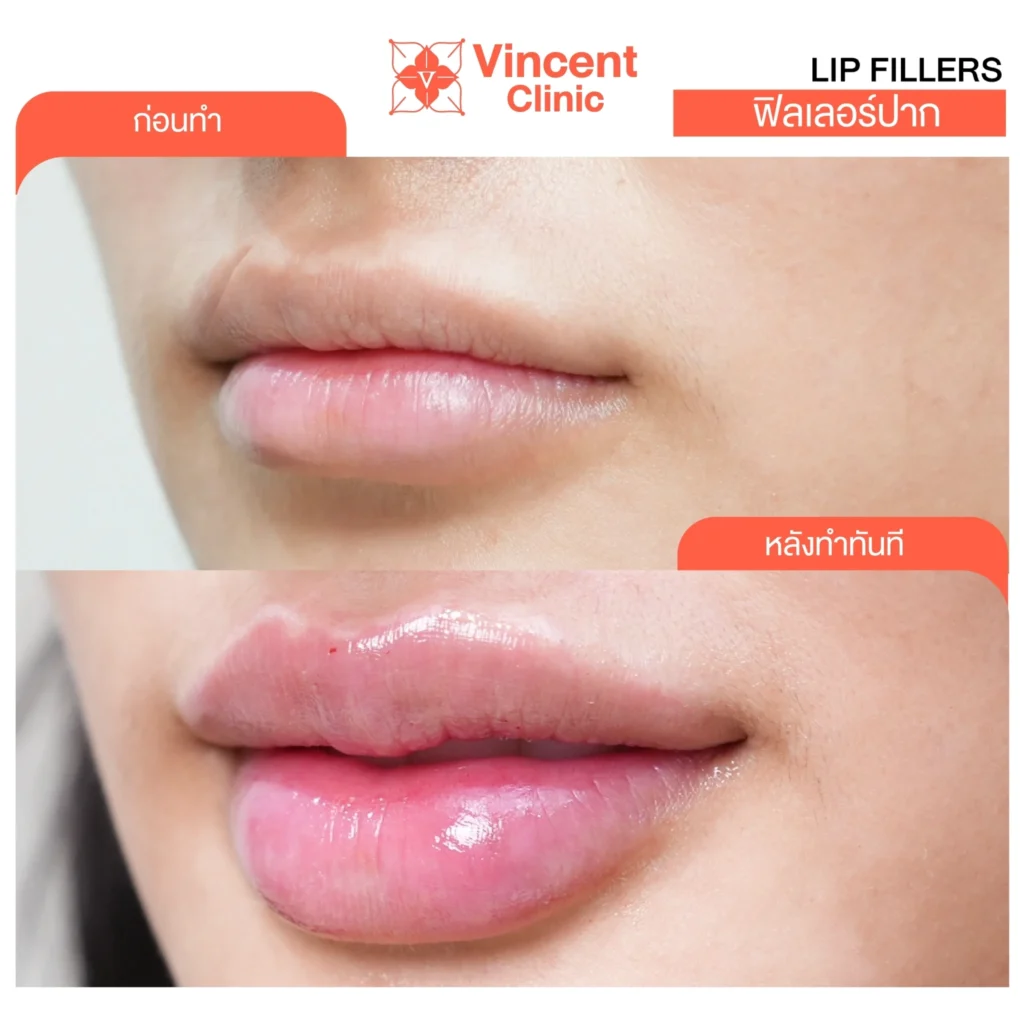 juvederm