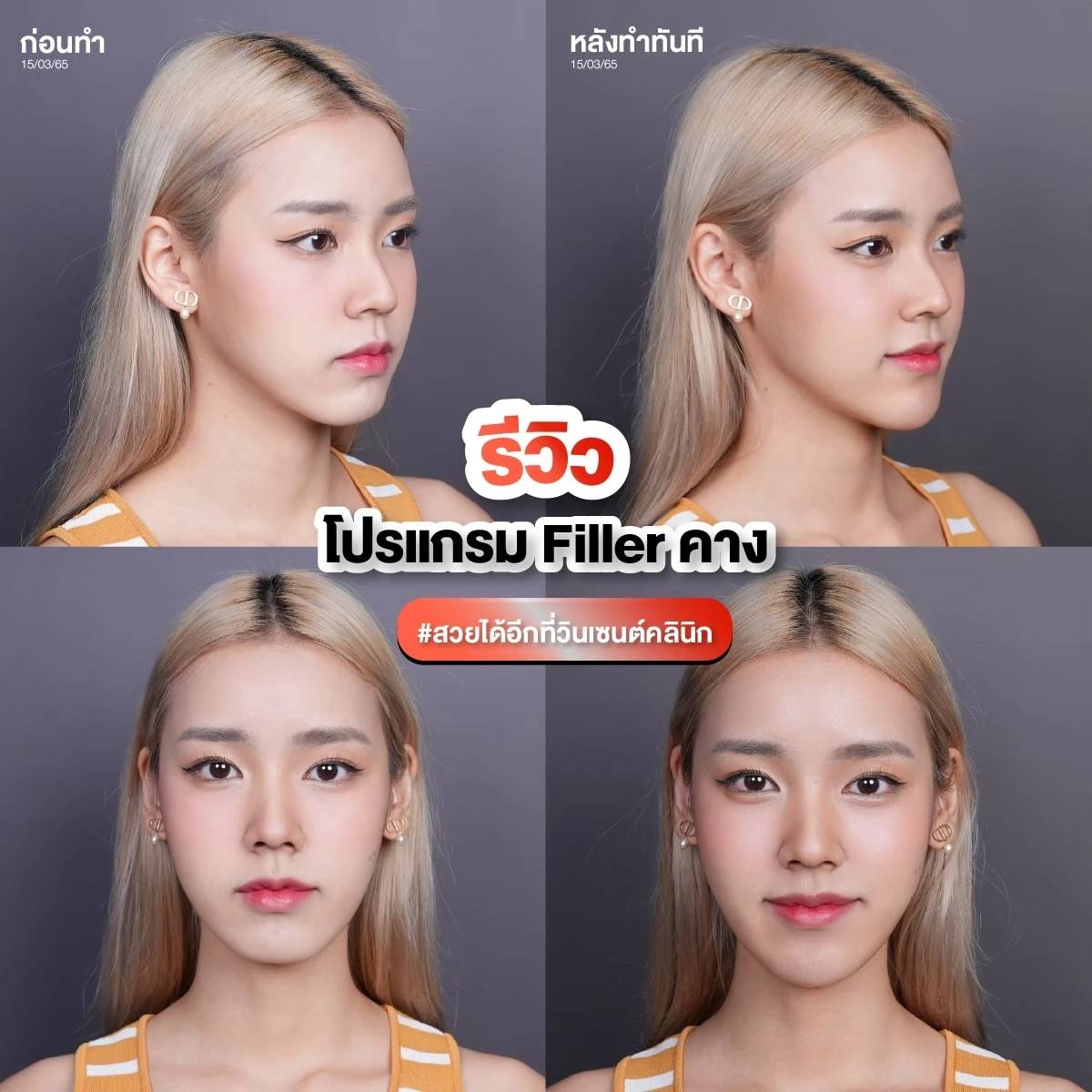 รีวิวโปรแกรมฟิลเลอร์คาง