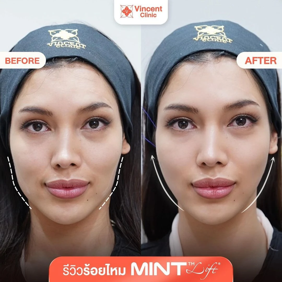 MintLift