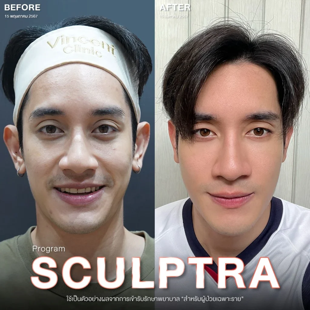 Sculptra