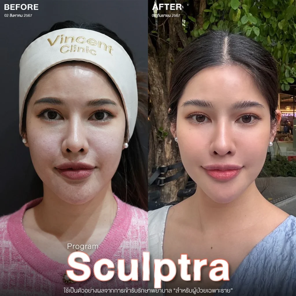 Sculptra