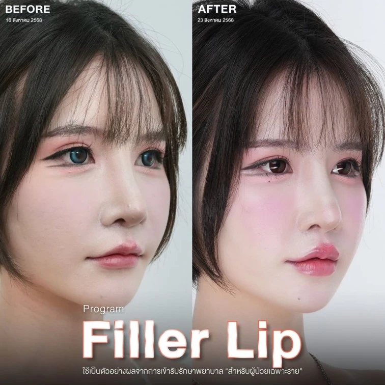 filler lip