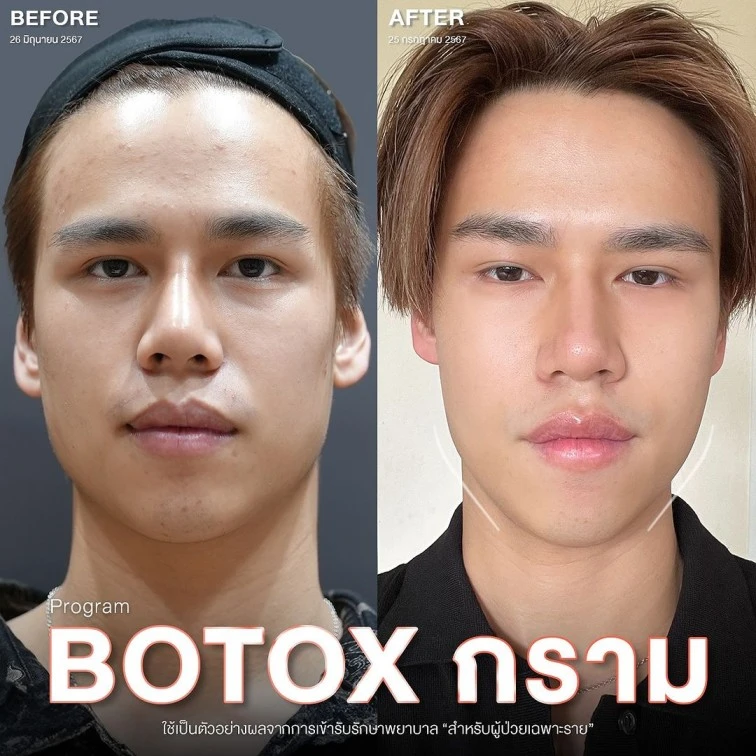 botox