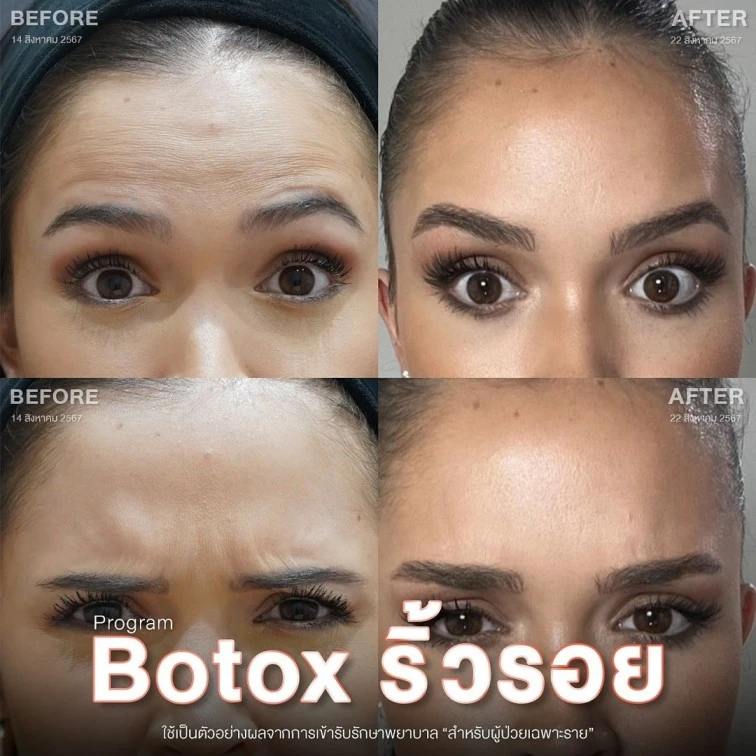 botox