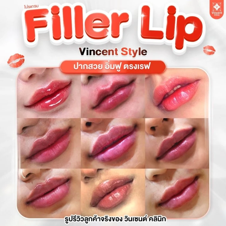 filler lip