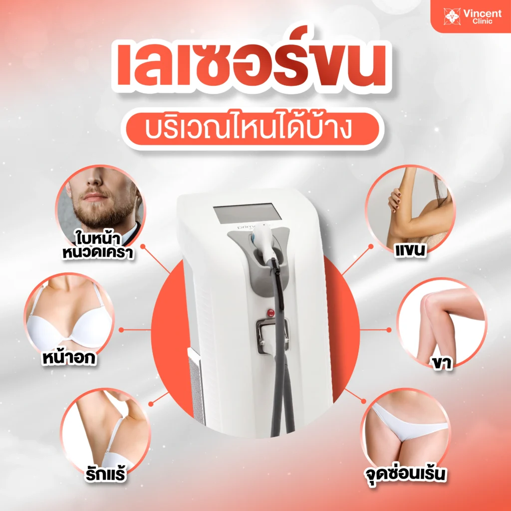 Diode Laser เลเซอร์ขน บริเวณไหนได้บ้าง