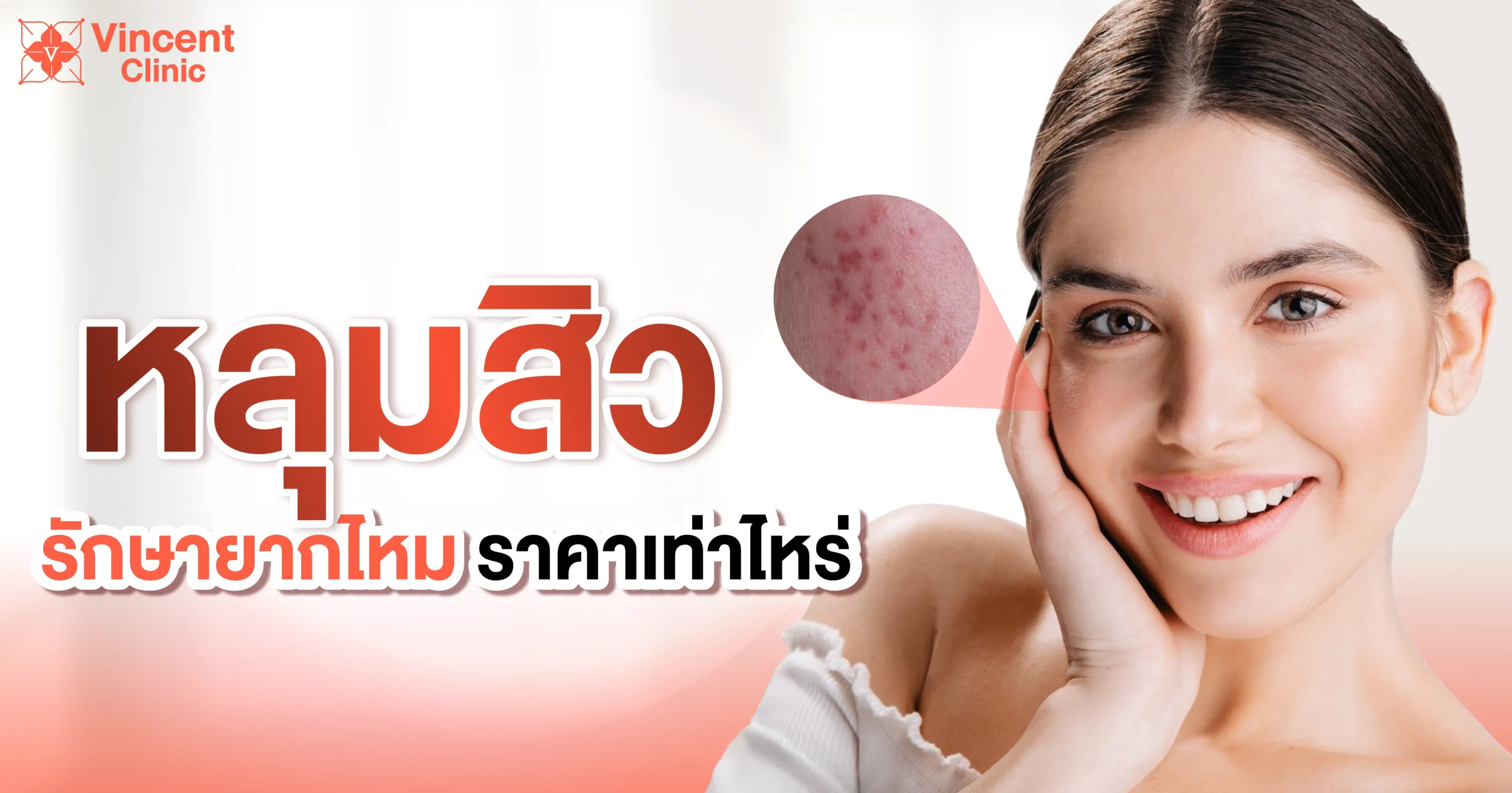 หลุมสิว รักษาหลุมสิว -02