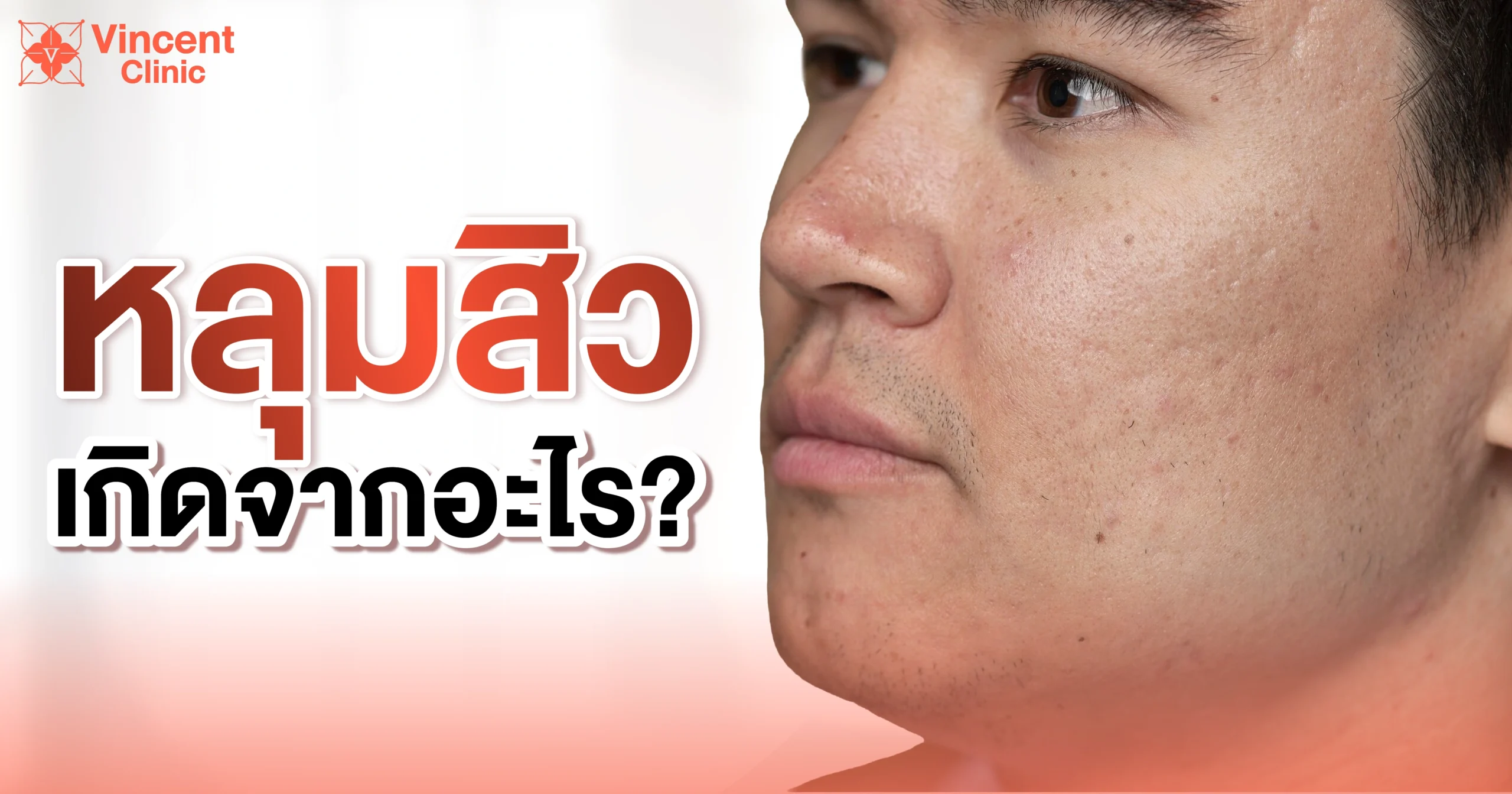 หลุมสิว รักษาหลุมสิว -03