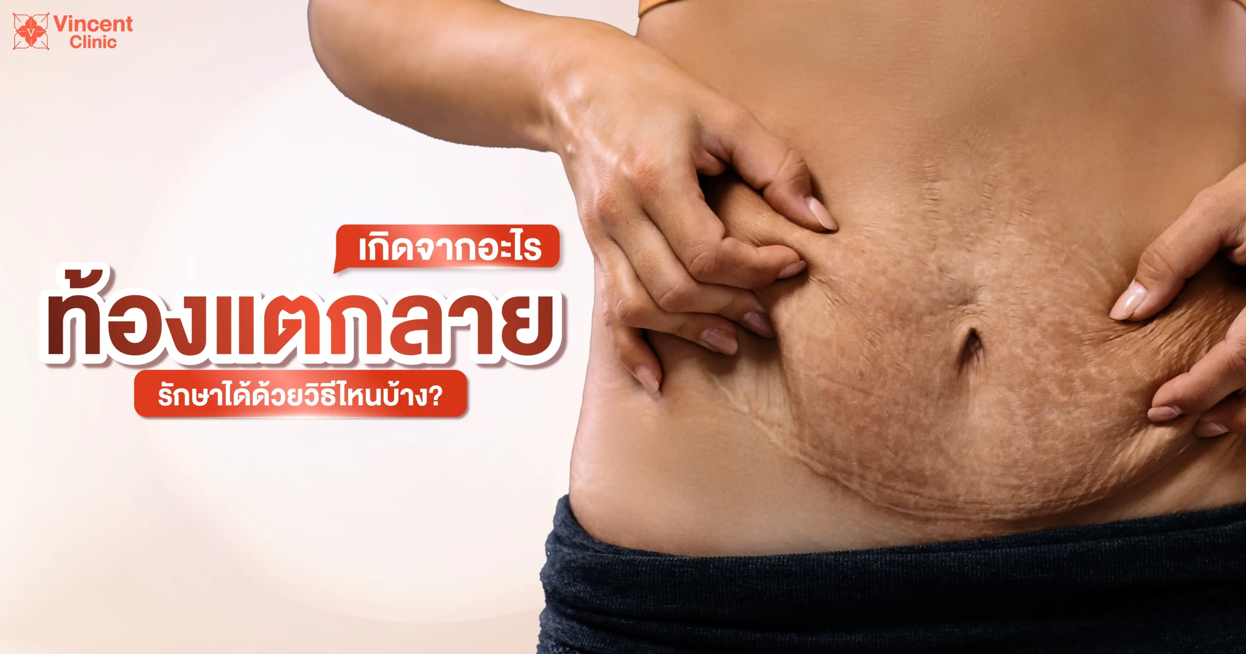 ท้องแตกลาย รักษาได้ด้วยวิธีใดบ้าง