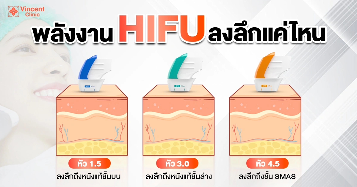 พลังงาน Hifu ลงลึกแค่ไหน