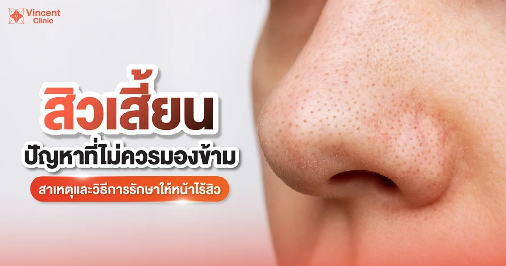 สิวเสี้ยนปัญหาที่ไม่ควรมองข้าม
