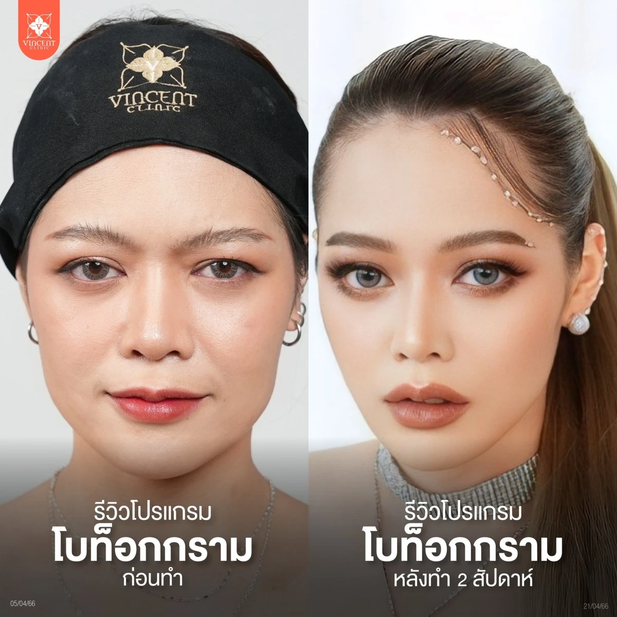 รีวิวโปรแกรมโบท็อกกราม