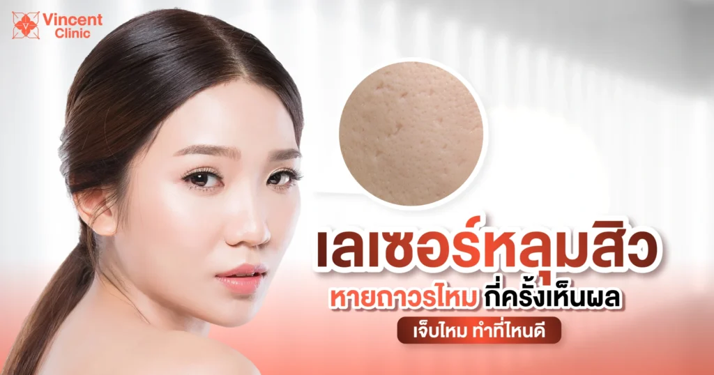 เลเซอร์หลุมสิวหายถาวรไหม