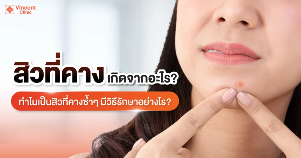 สิวที่คางเกิดจากอะไร