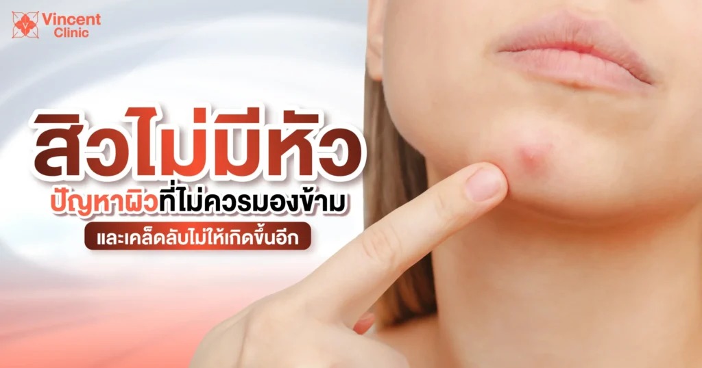 สิวไม่มีหัวปัญหาผิวที่ไม่ควรมองข้าม