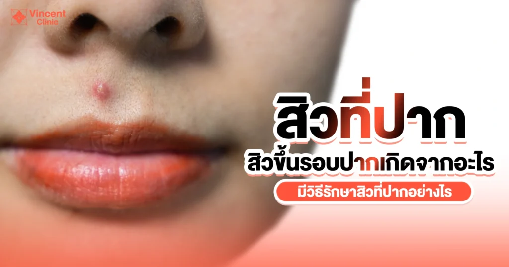 สิวที่ปากเกิดจากอะไร