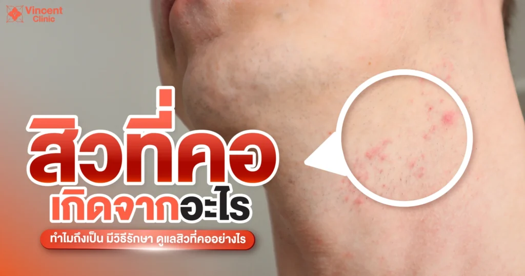 สิวขึ้นที่คอเกิดจากอะไร