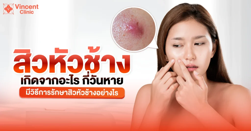 สิวหัวช้างเกิดจากอะไร กี่วันหาย