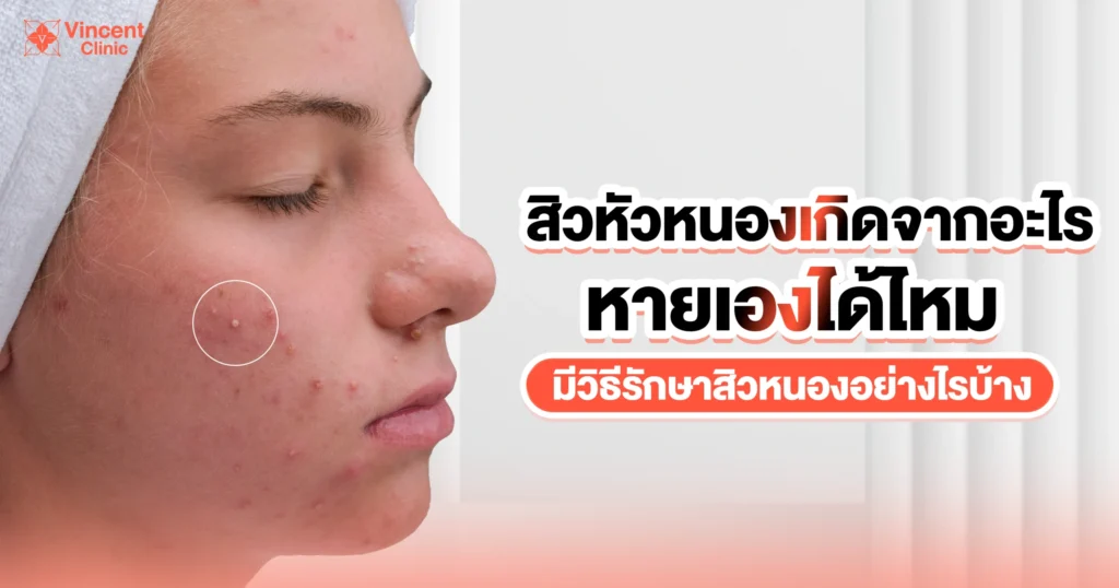 สิวหัวหนองเกิดจากอะไร หายเองได้ไหม