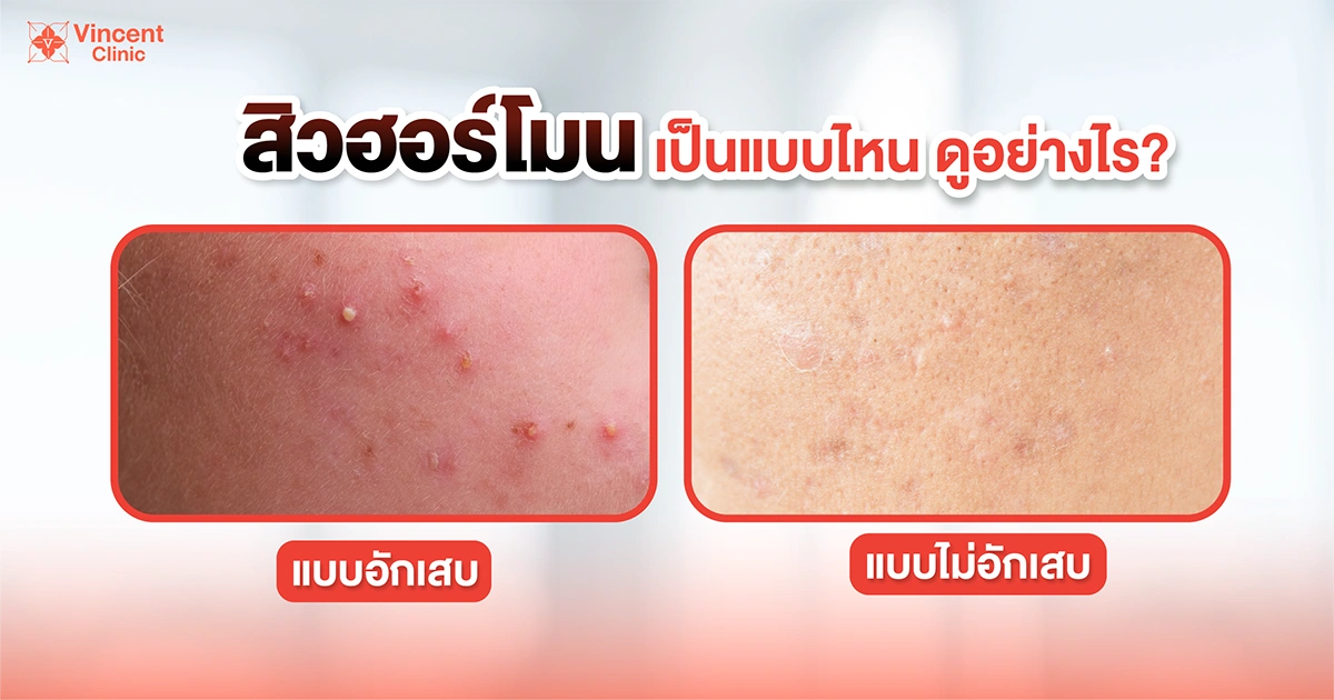 characteristics of hormonal acne สิวฮอร์โมนเป็นแบบไหน