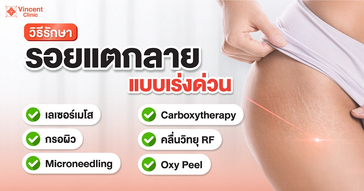 Fast treatment for stretch marks รักษารอยแตกลายแบบเร่งด่วน