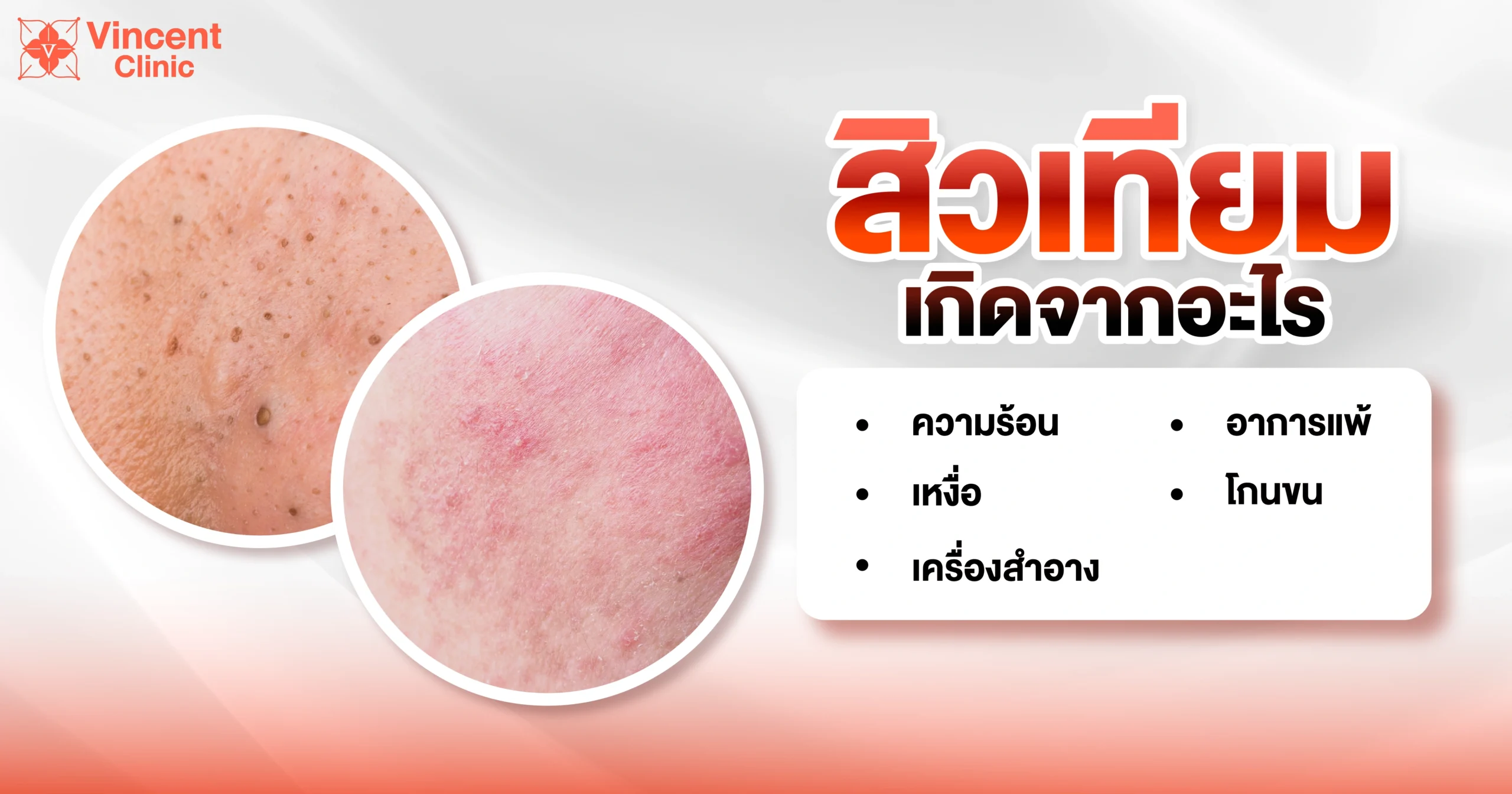 สิวเทียมเกิดจากอะไร