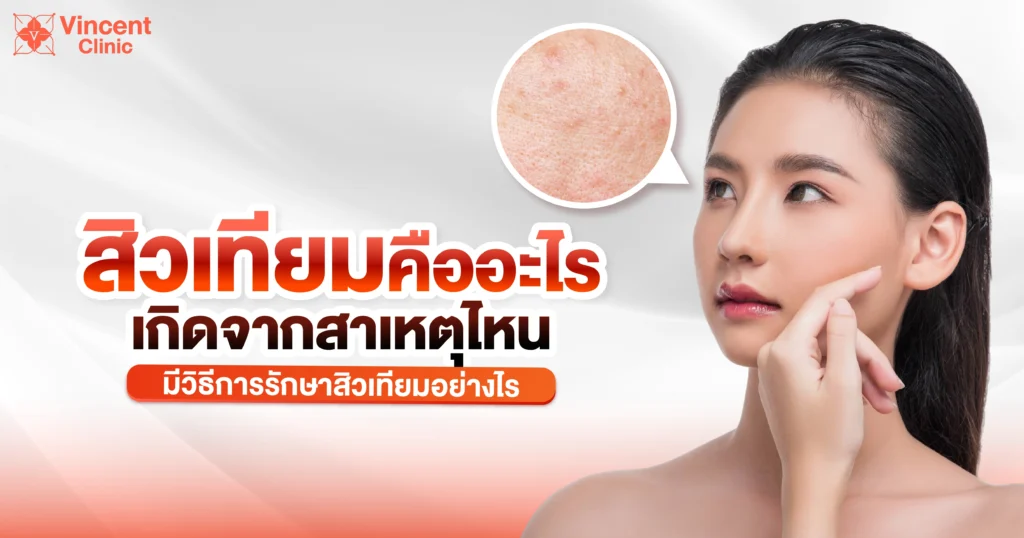 สิวเทียม