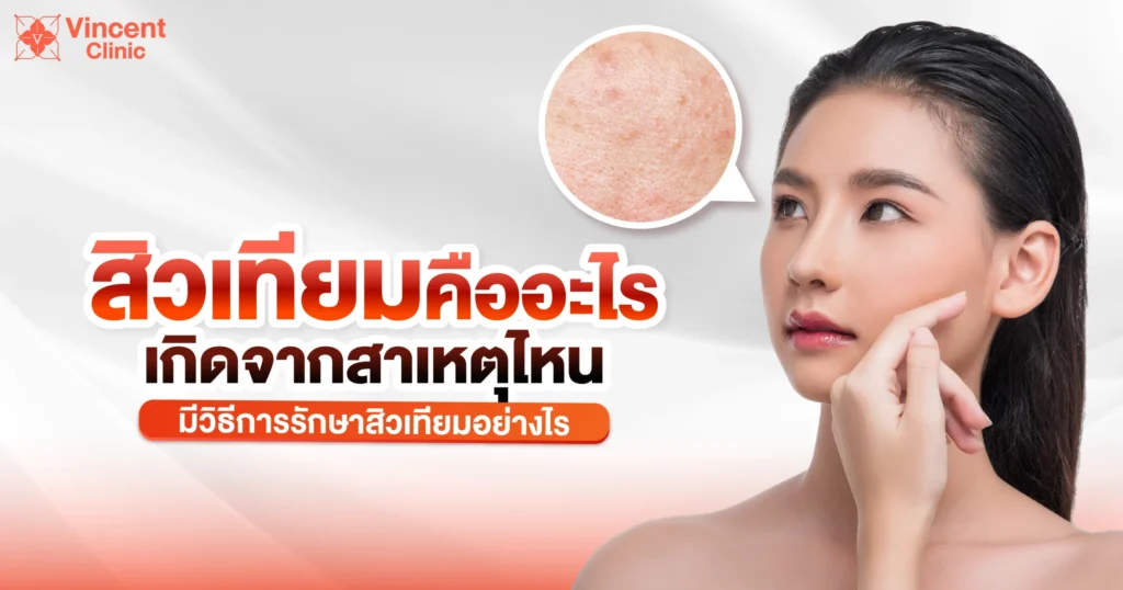 สิวเทียม