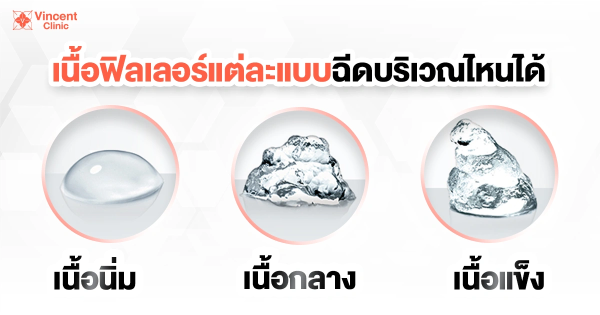 ลักษณะของเนื้อฟิลเลอร์