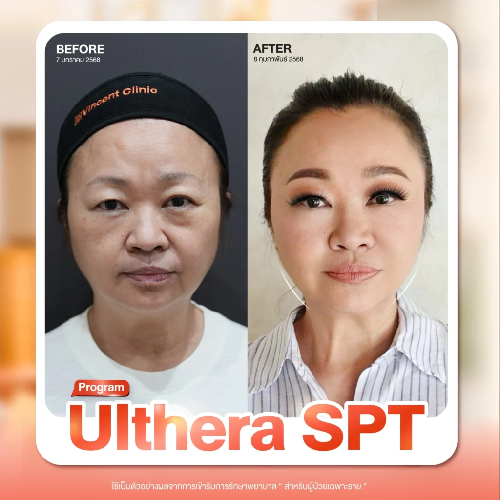 review-ulthera-spt1
