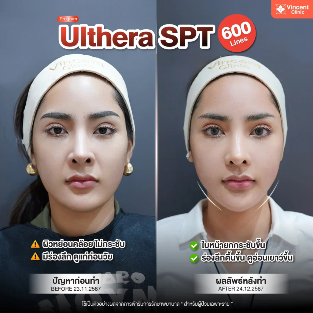 review-ulthera-spt3