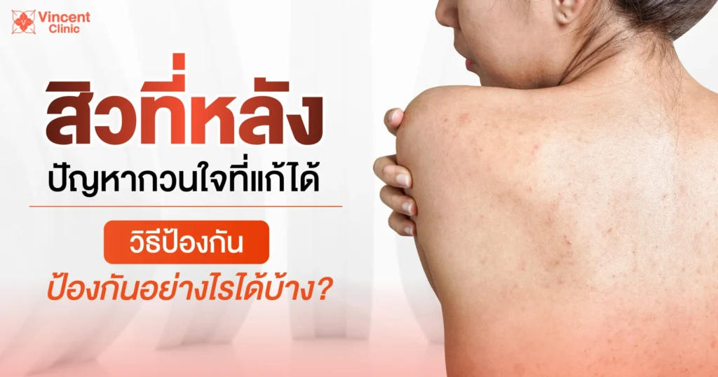 วิธีป้องกันสิวที่หลัง