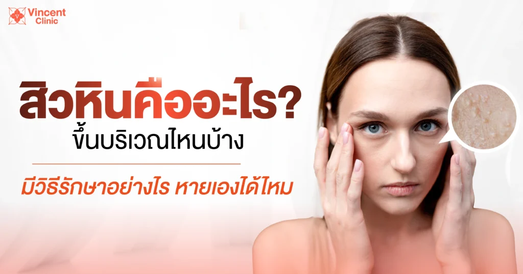 สิวหินคืออะไร