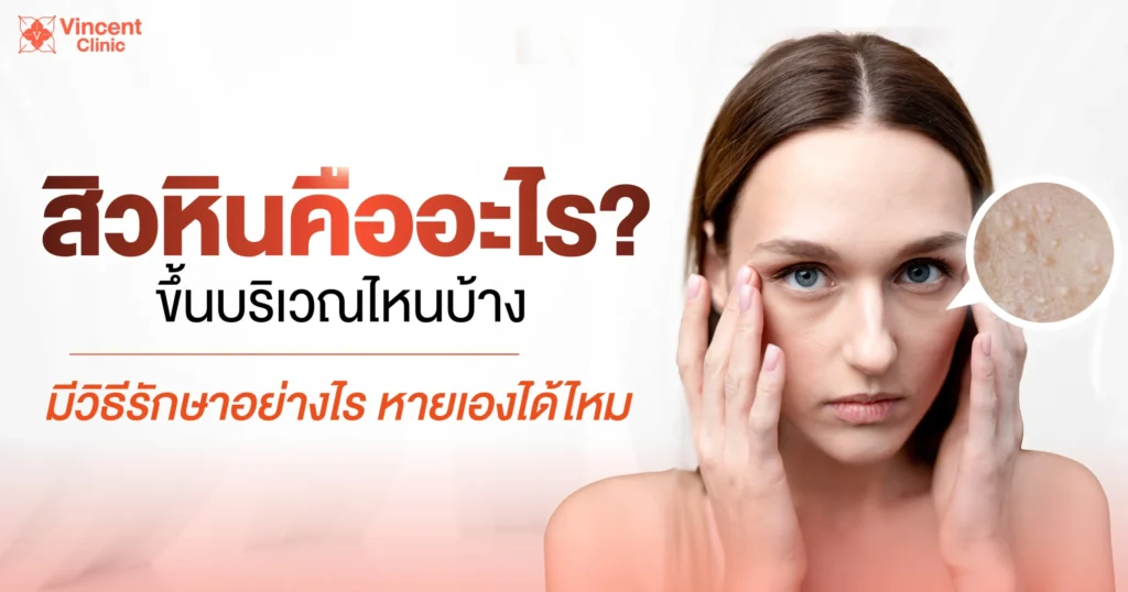 สิวหินคืออะไร
