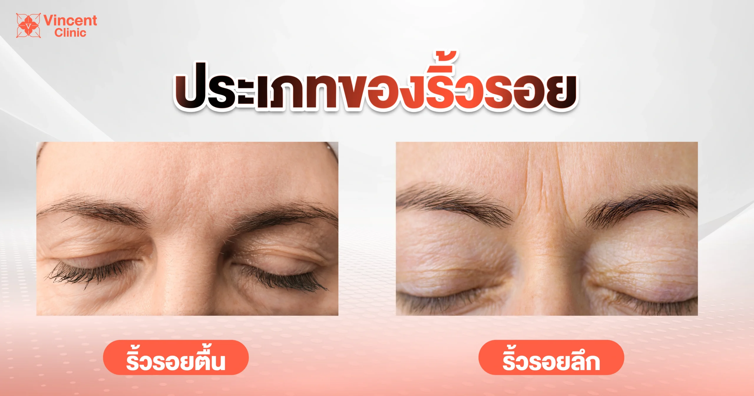 ประเภทริ้วรอย