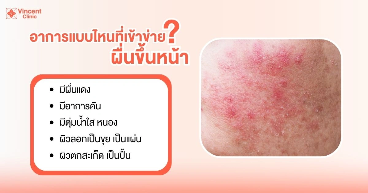ผื่นขึ้นหน้าเป็นแบบไหน