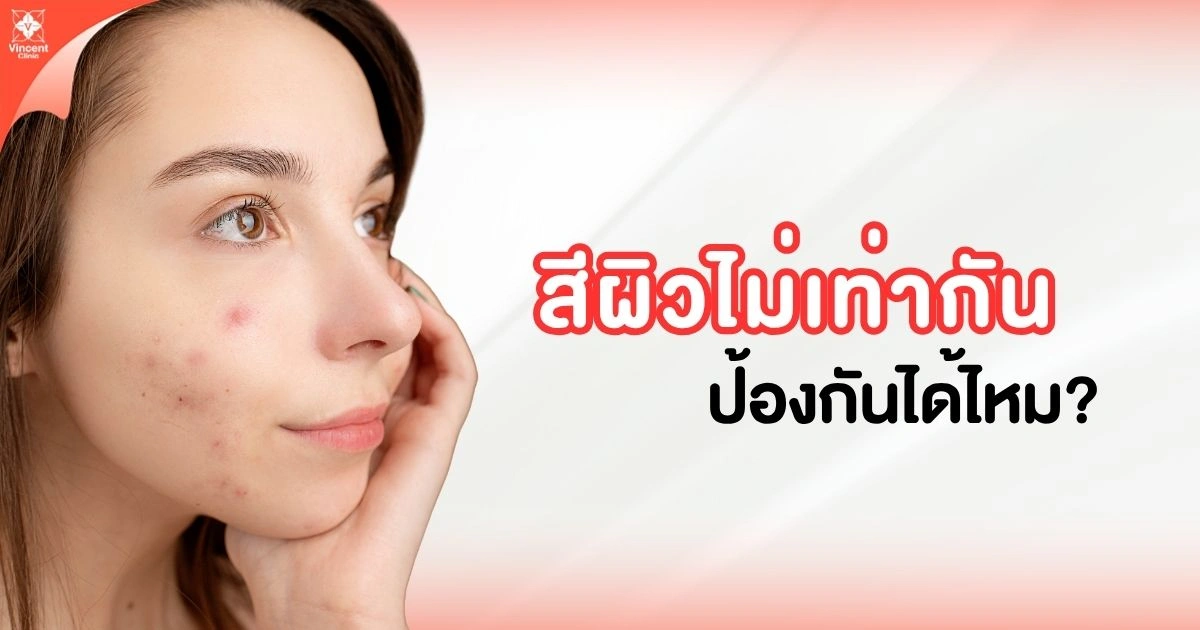 สีผิวไม่เท่ากันป้องกันได้ไหม