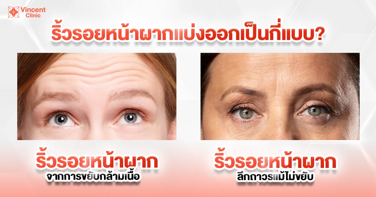 ริ้วรอยหน้าผากมีกี่แบบ