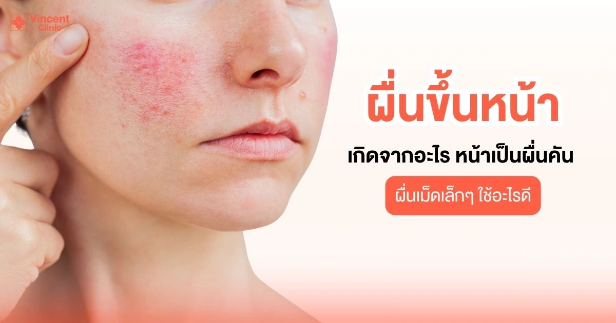 ผื่นขึ้นหน้า เกิดจากอะไร