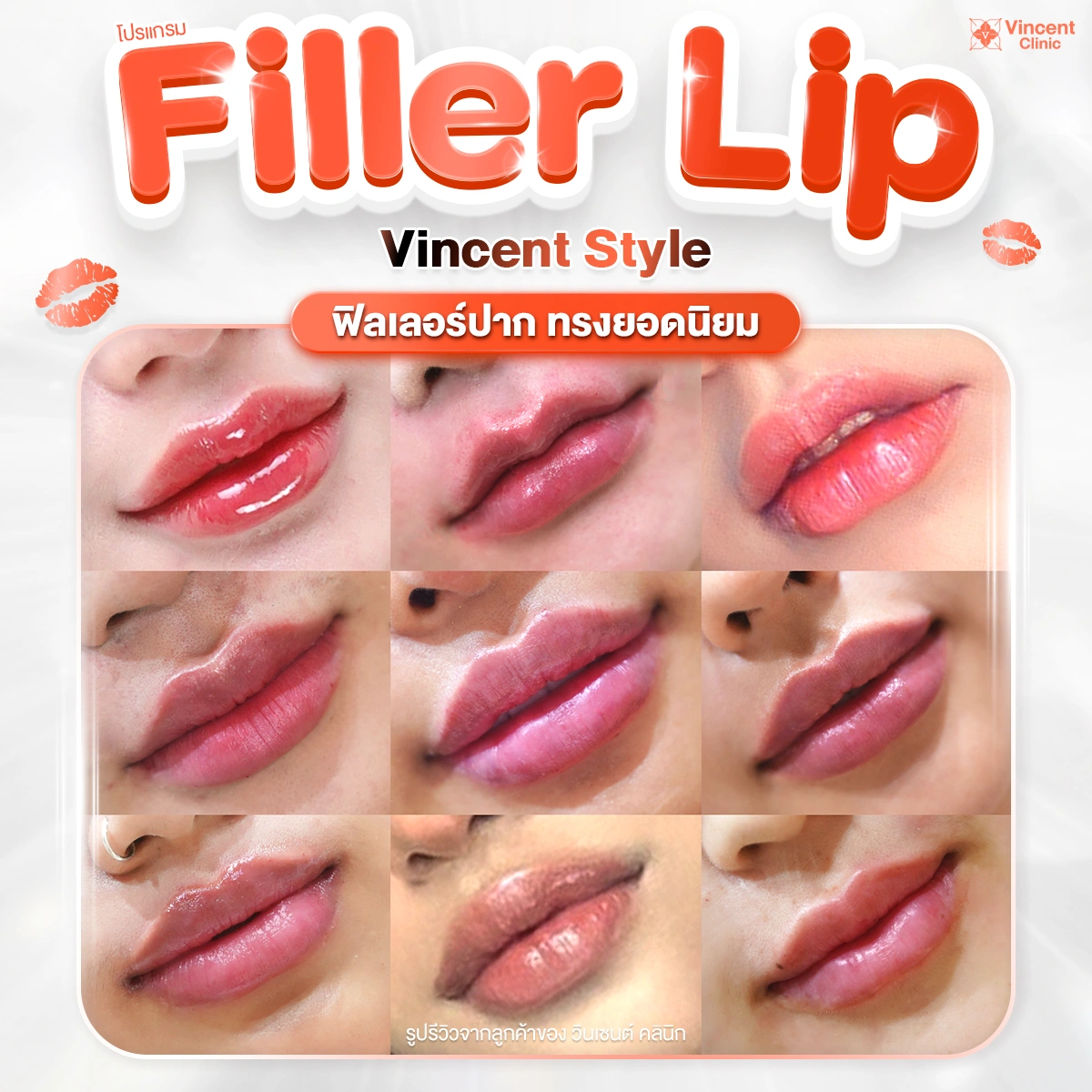 ทรงปากสวยๆ ด้วยการฉีดฟิลเลอร์ปากกับ Vincent Clinic