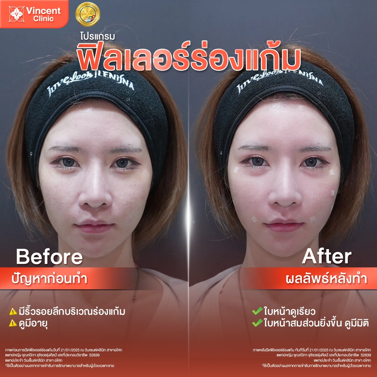 รีวิวฉีดฟิลเลอร์ร่องแก้ม ที่ Vincent Clinic