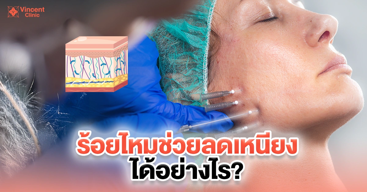 ร้อยไหมช่วยลดเหนียงได้อย่างไร?