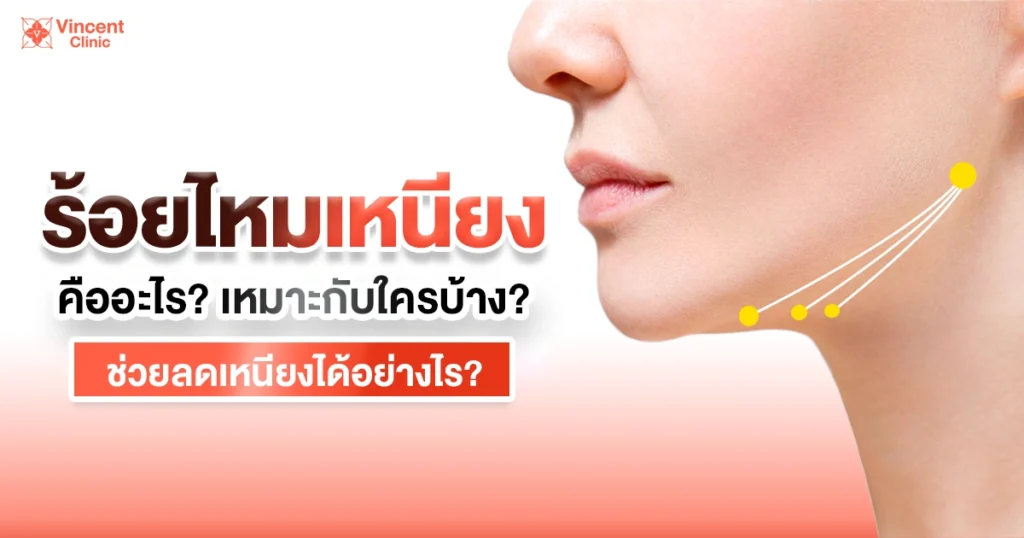 ร้อยไหมเหนียง คืออะไร เหมาะกับใครบ้าง ช่วยลดเหนียงได้อย่างไร?