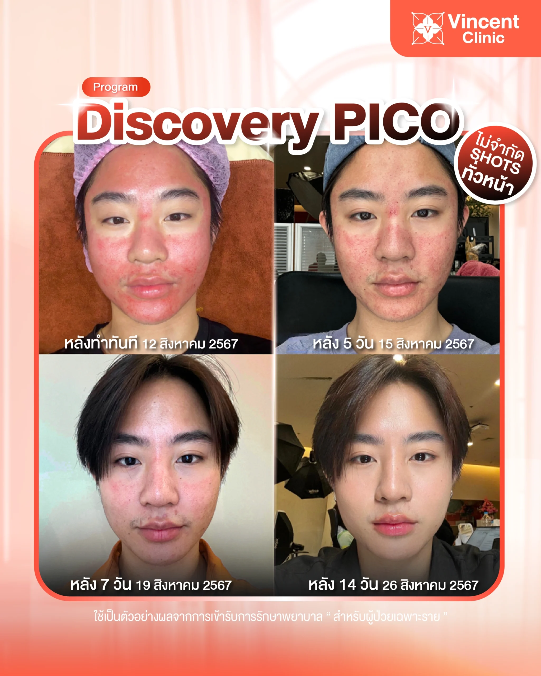 review pico laser