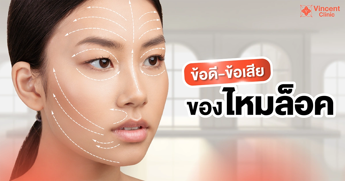 ไหมล็อคคืออะไร