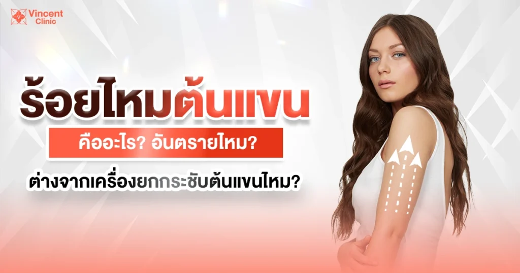 ร้อยไหมต้นแขนคืออะไร