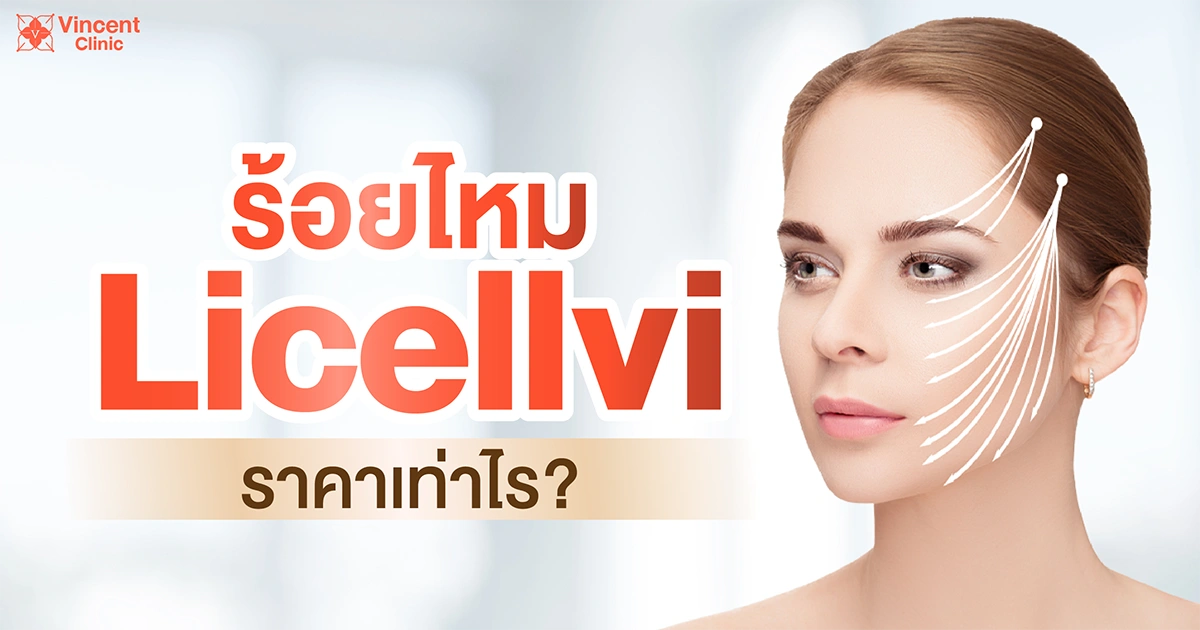 How much does Licellvi thread lifting cost? ร้อยไหม licellvi ราคาเท่าไหร่